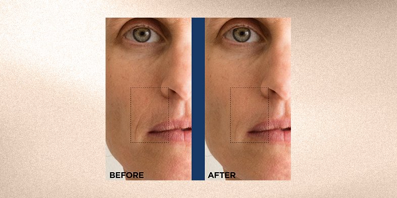 Before and after picture of woman's skin after using retinol